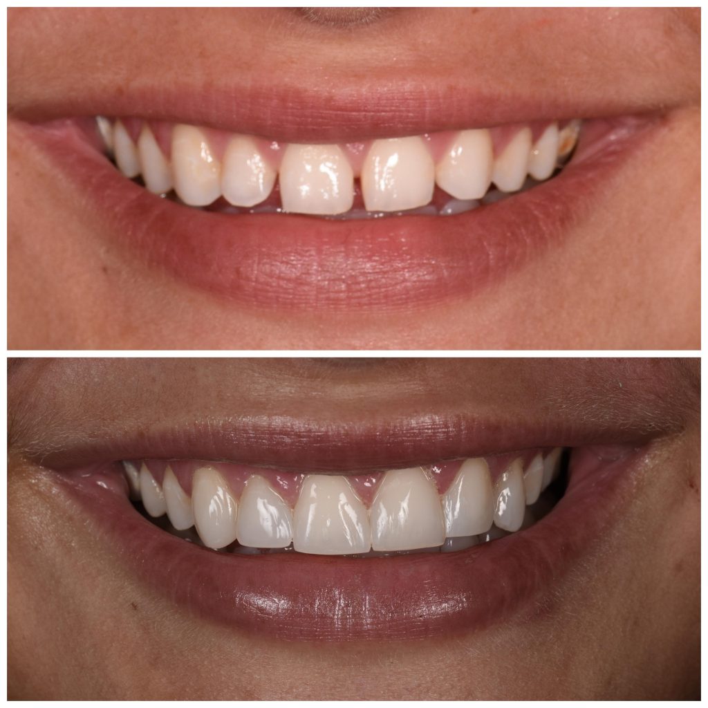 Pasient ved Eiksmarka Tannlegesenter før og etter Kosmetisk tannbehandling