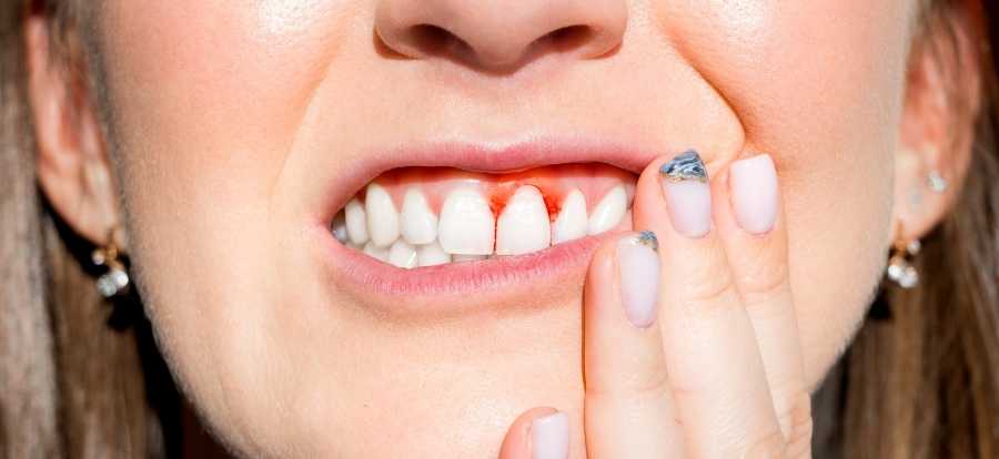 Kvinne med periodontitt - tannkjøttbetennelse