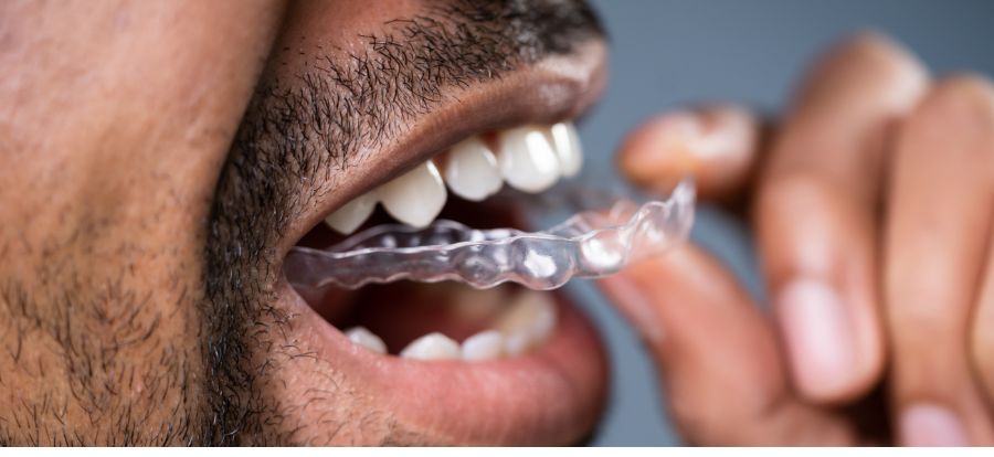 Usynlig tannregulering for voksne