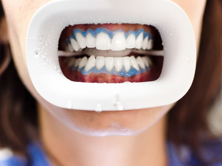 Bleking i Oslo og Bærum, behandlingen gjør at tennene blekes mye mer raskere enn behandlinger som ikke er profesjonelle. 