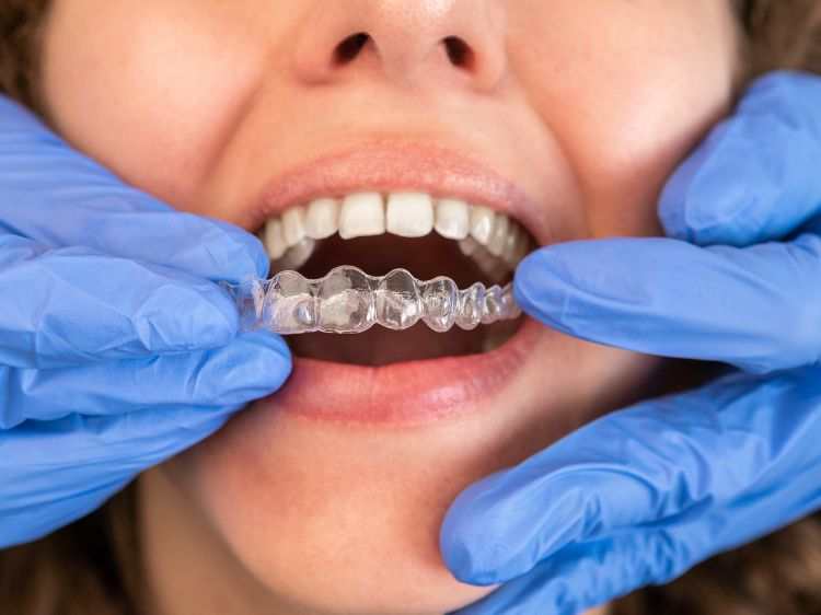 Hos din tannlege får du plastskinner som over tid vil rette opp dine tenner