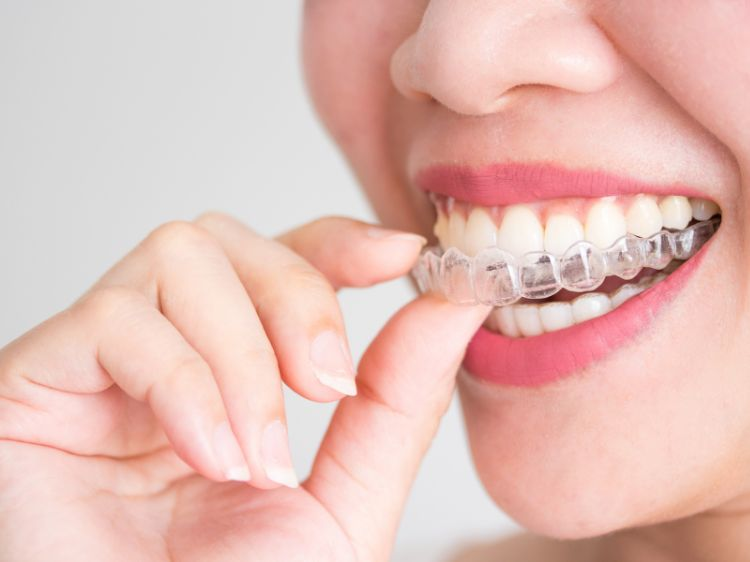 Usynlig tannregulering, synlige resultater, du får svar om forventet resultatet