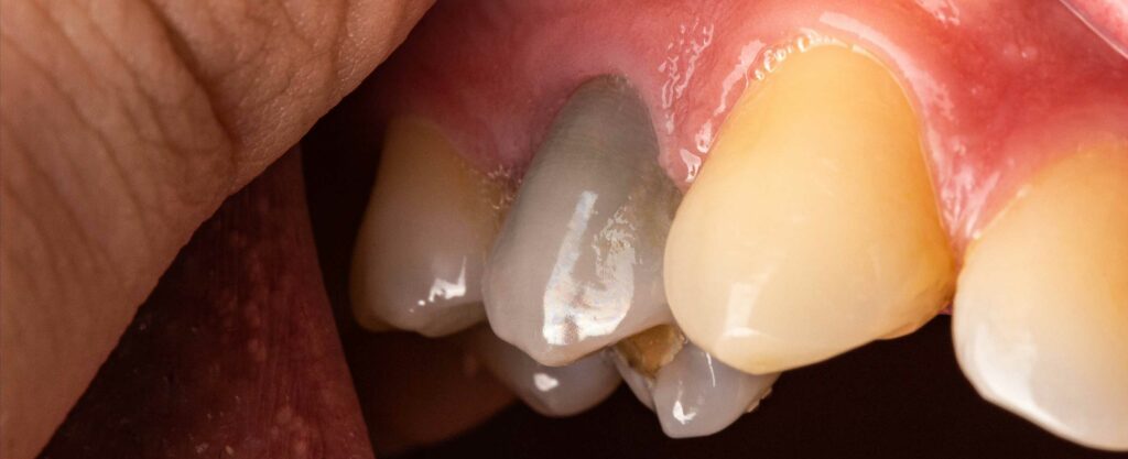 Bilde av en død tann som har endret farge.