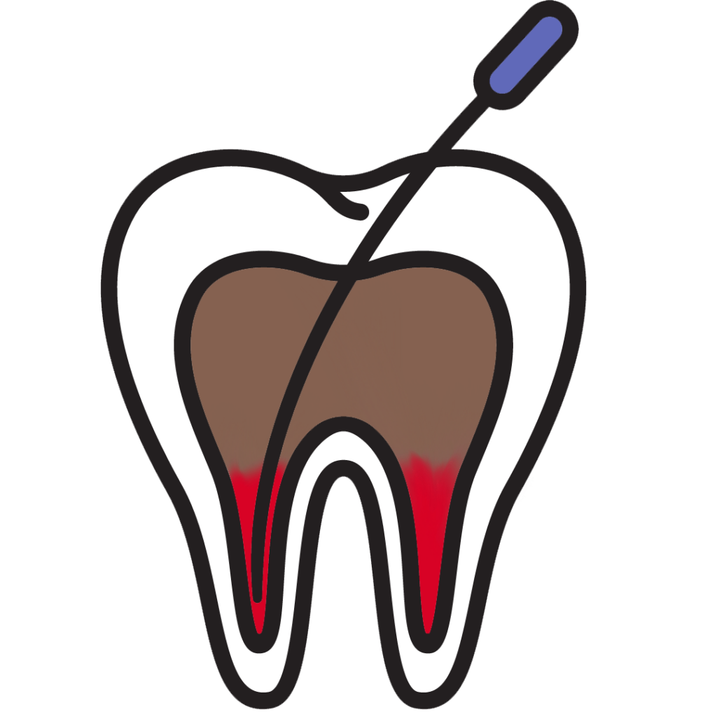 Infeksjon blir renset inne i tannen.