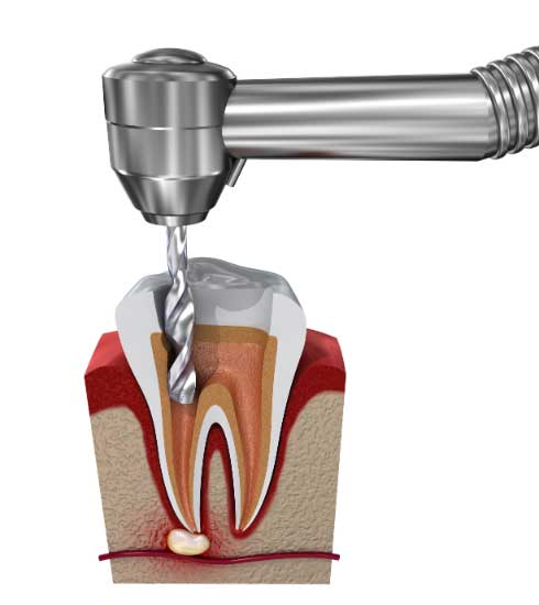 Tann blir båret i for utrensning av pulpa.