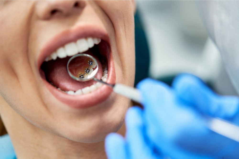 Incognito tannregulering er en usyling men fast tannregulering bak tennene