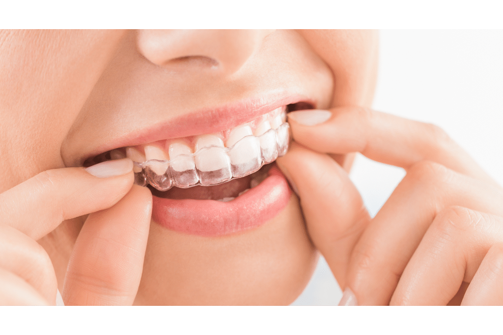 Invisalign er en usynlig og avtagbar tannregulering med gjennomsiktige skinner