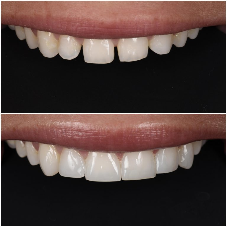 Prosedyren kan tette mellomrom mellom tennene og gjøre de lengere