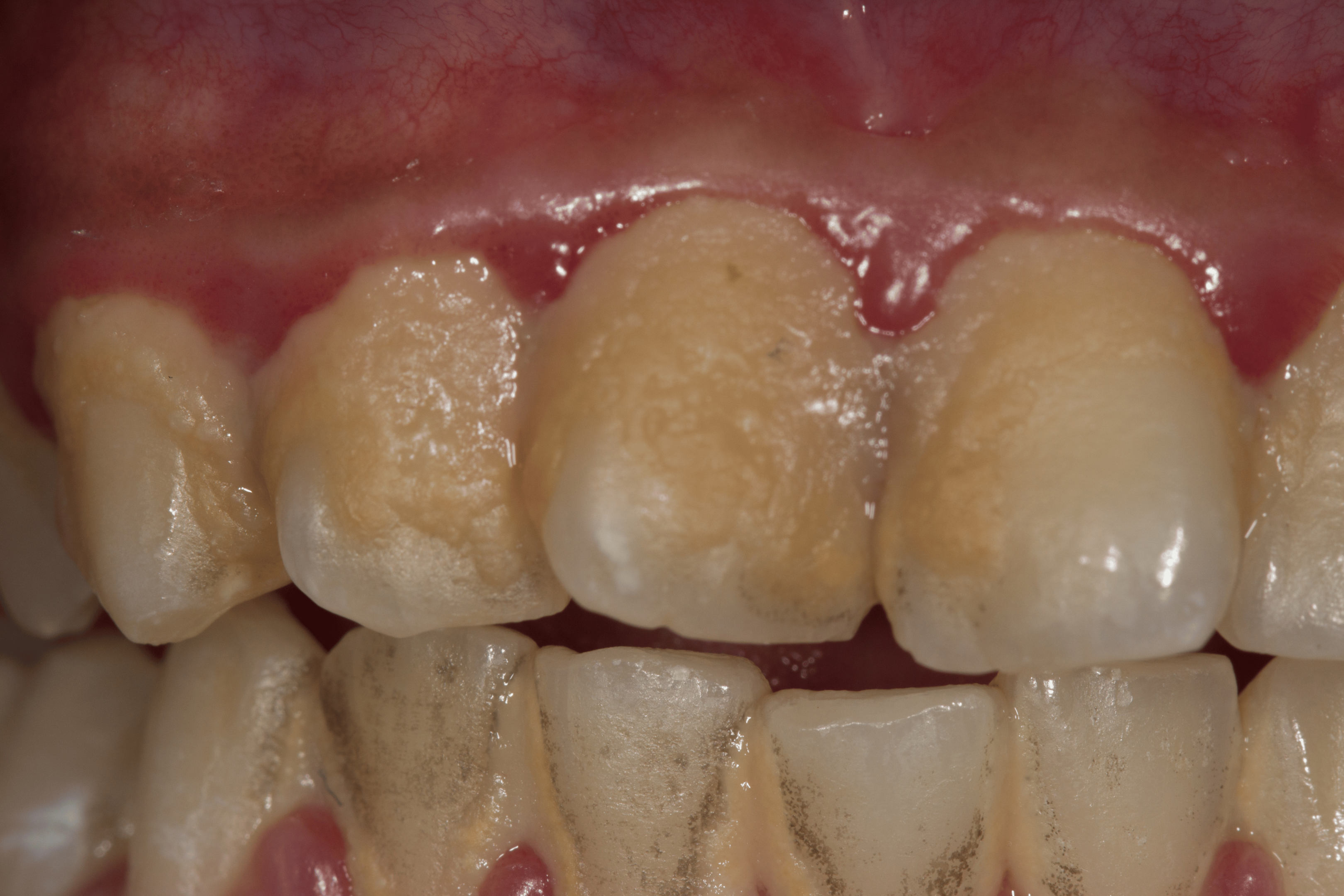 Tannkjøttsykdom starter oftest med oppbygning av plakk og tannstein