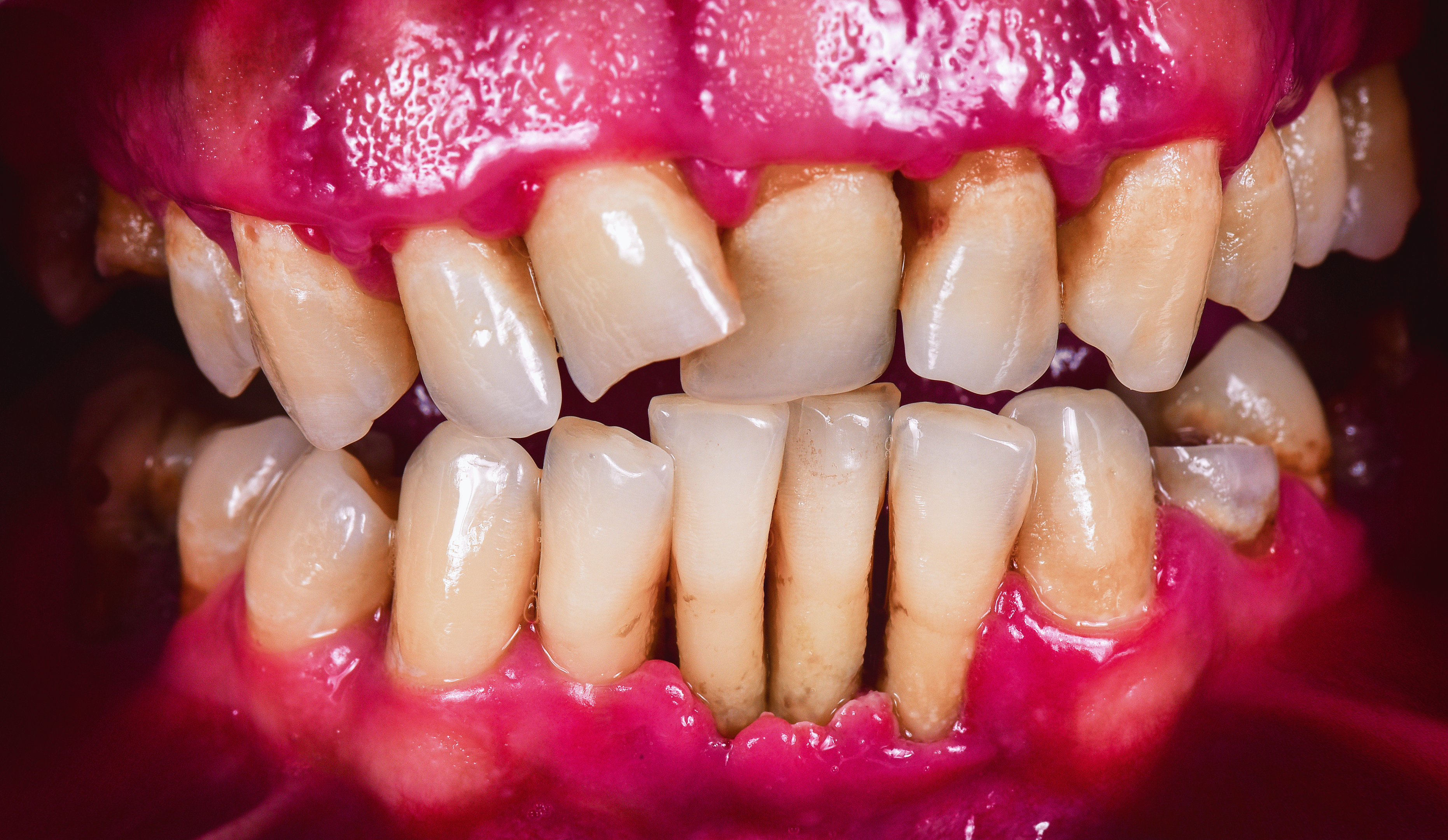 Tankjøtt som trekker seg tilbake er et symptom i følge av periodontitt