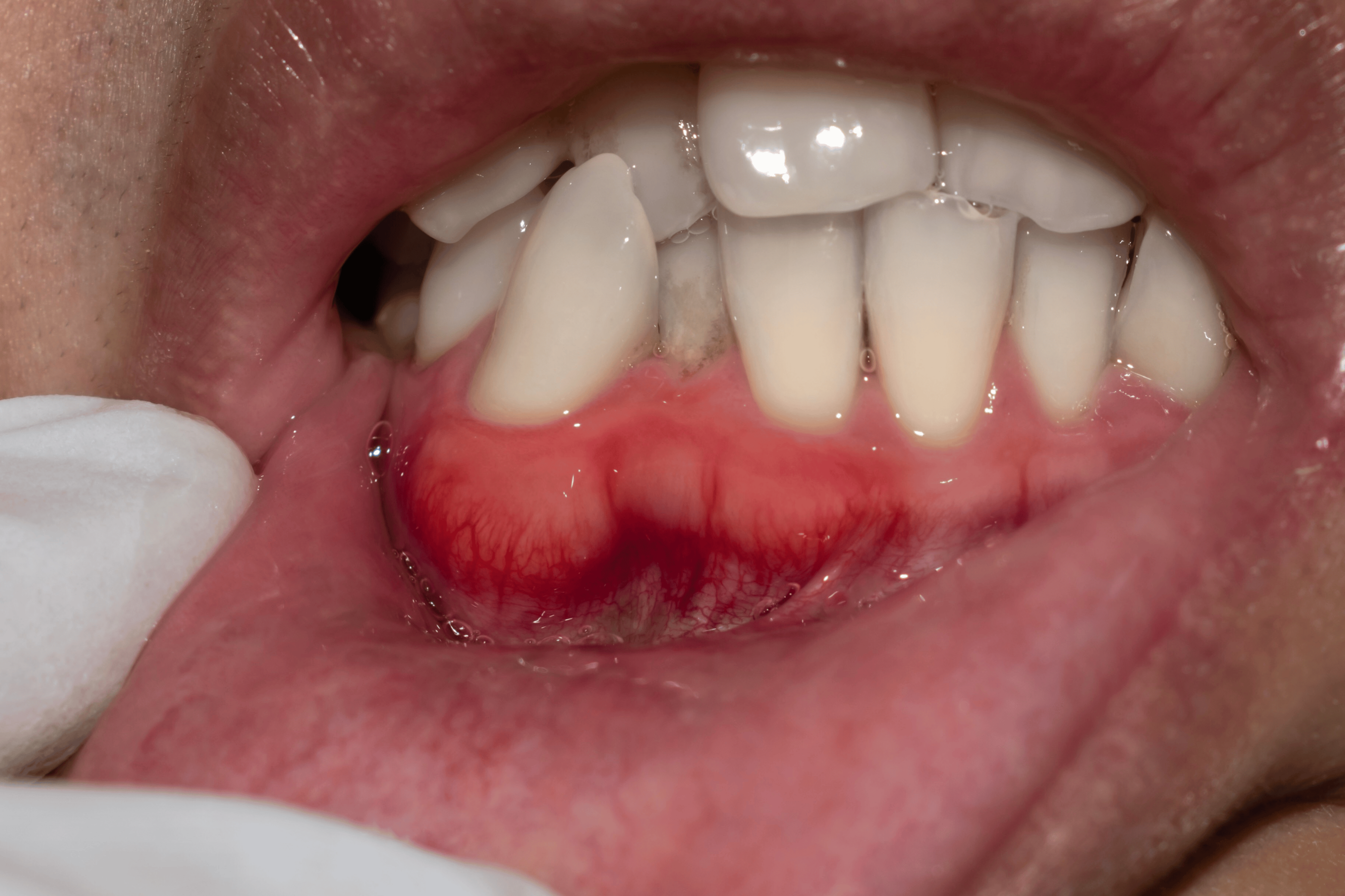 Gingivitt starter utten for mange symptomer, men man kan merde rødere tannkjøtt