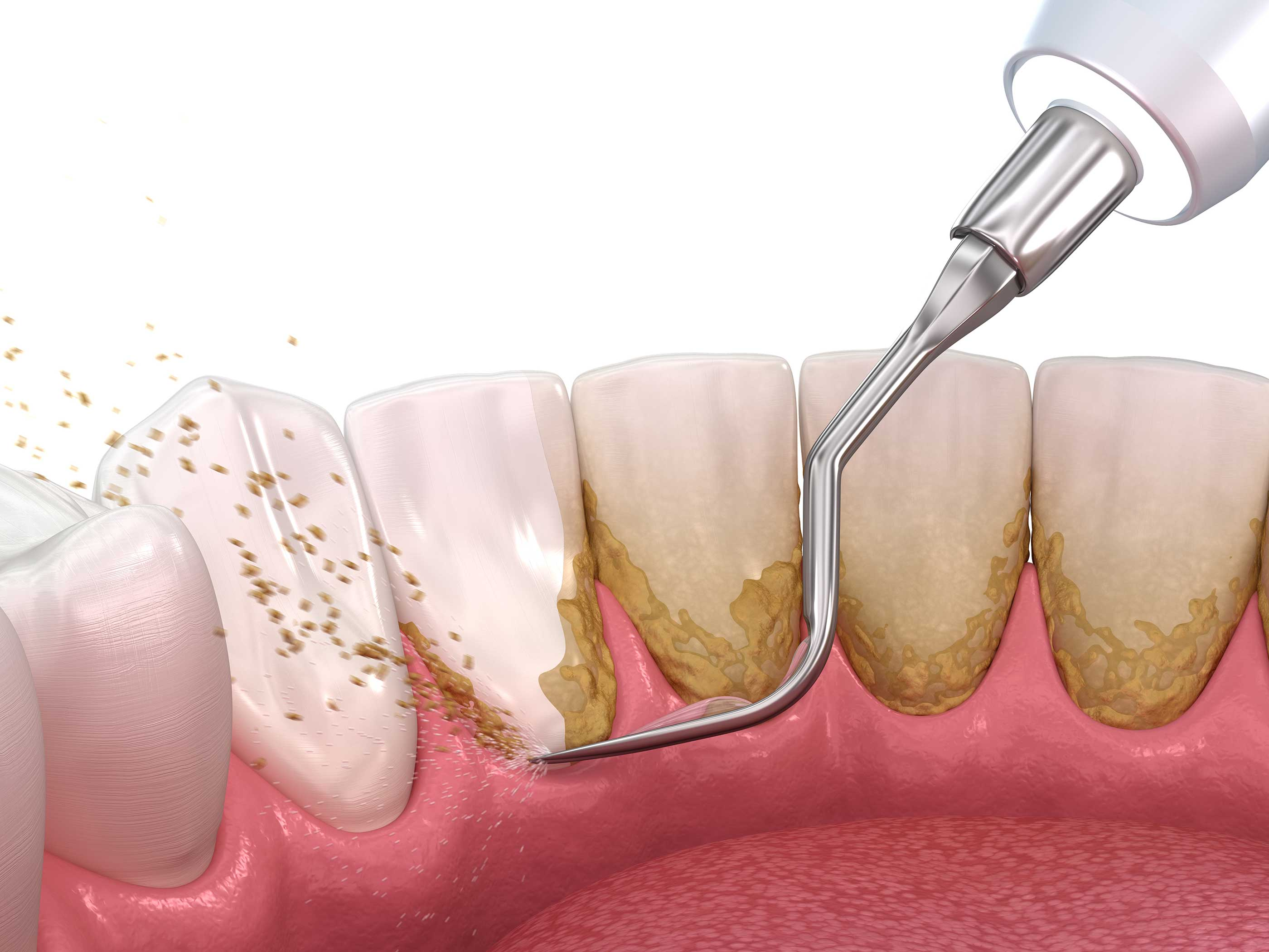 Hos tannlegen kan du fÃ¥ fjernet tannstein