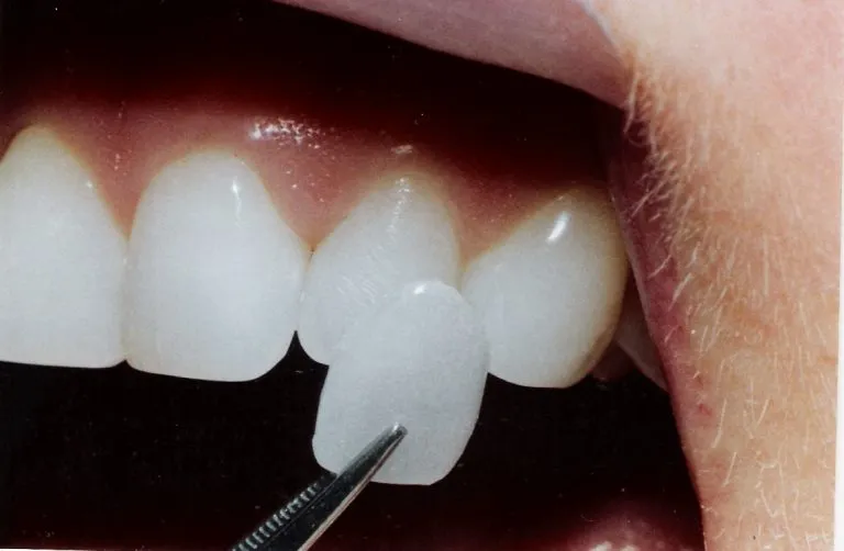 Tannlegen setter på en fasett over pasientens naturlige tenner