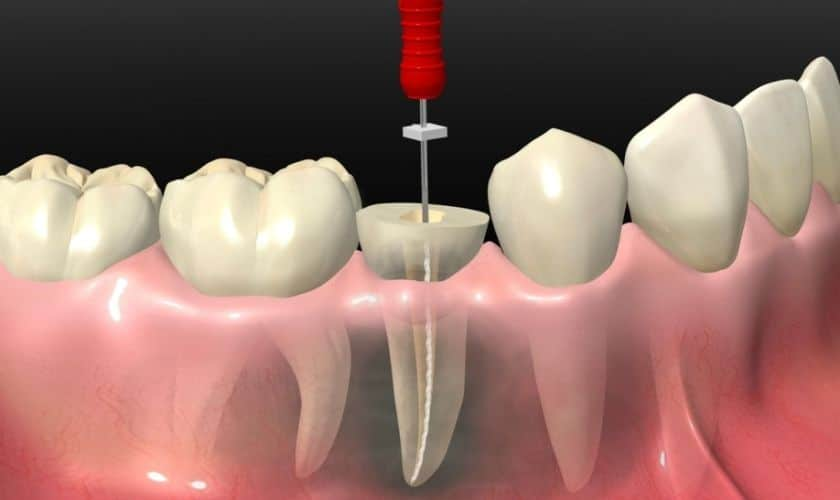Dersom du har smerter i en tann kan det være at du trenger en rotfylling hos tannlegen