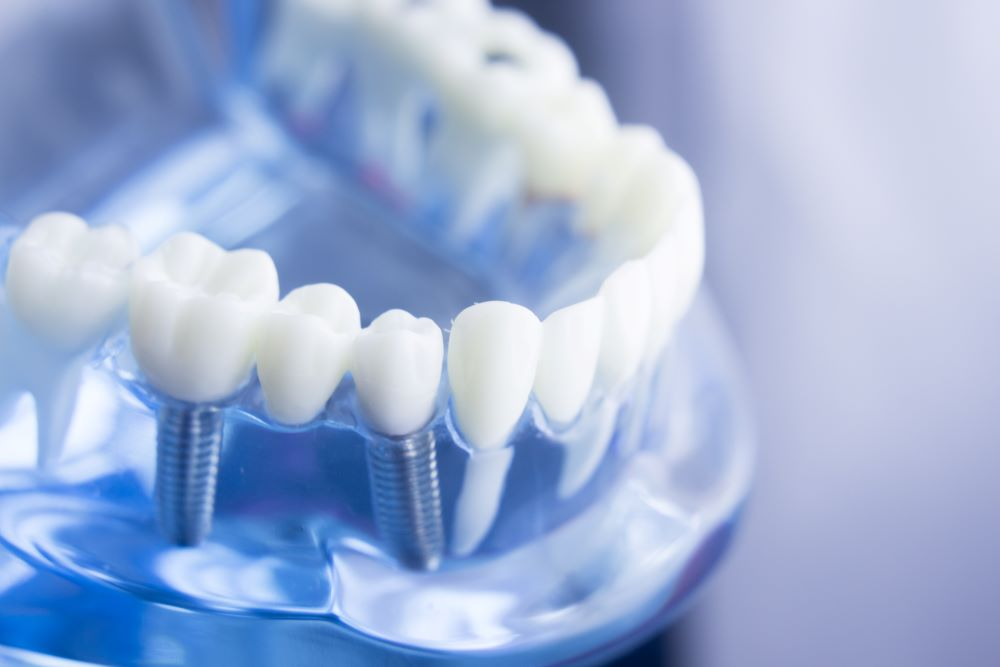 Delproteser kan festes til tannimplantater 