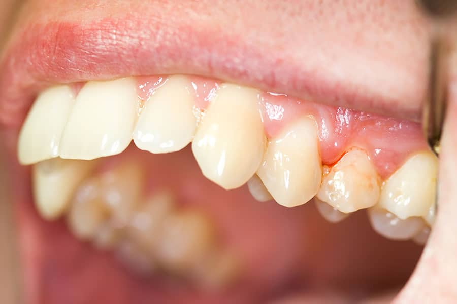 Tannkjøtt som er rødt mellom tennene