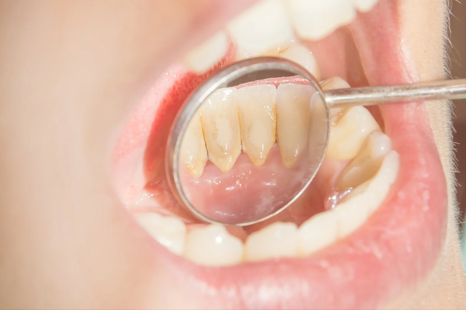 Person som har dannelse av tannstein på tennene