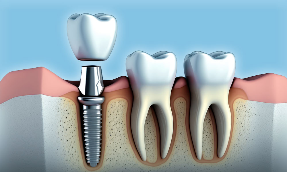 Et implantat fungerer som en kunstig tannrot