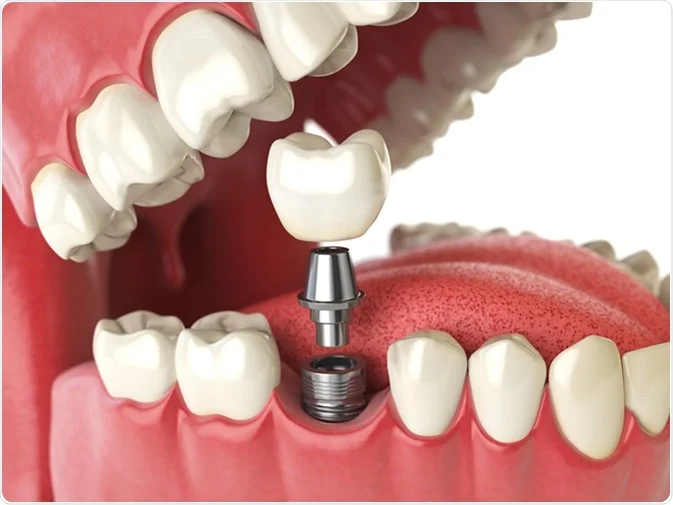 Implantater kan erstatte tapte tenner