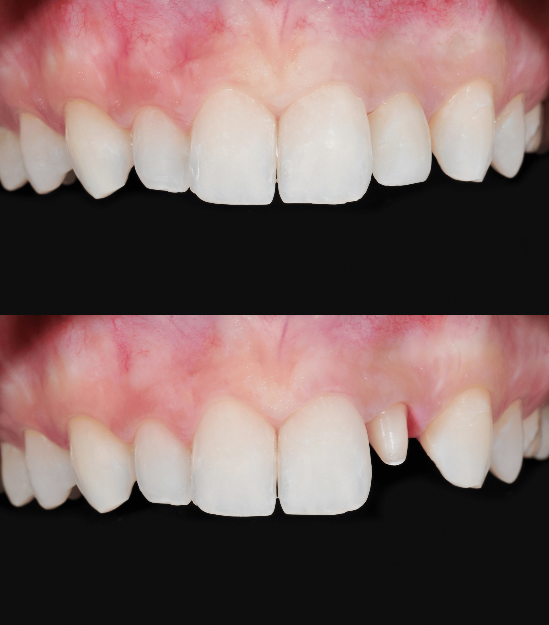 Eksempel på tann før og etter krone