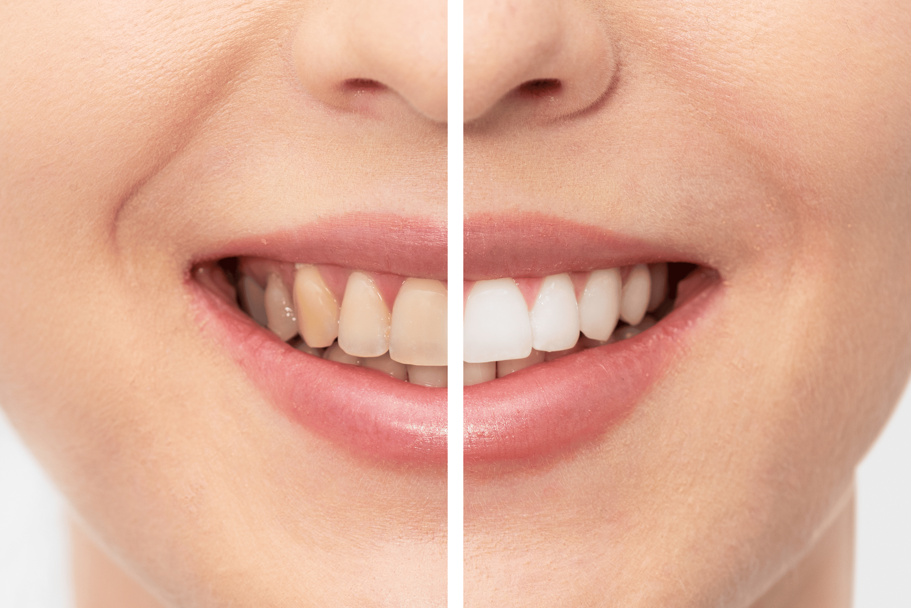 Fra tannmisfarging til strålende smil, viser før og etter effekten