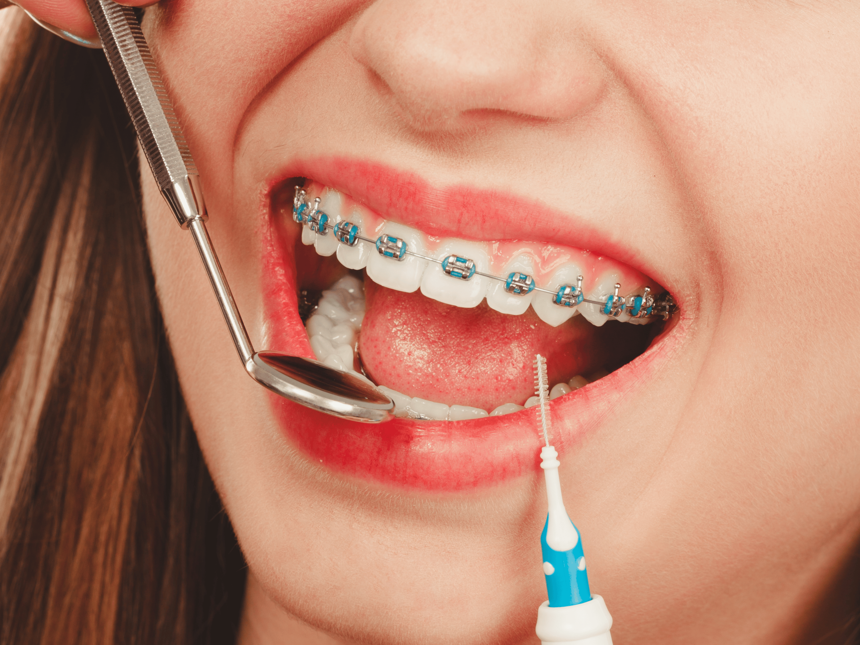 Kvinne med tradisjonel metallregullering - tannregulering for voksne