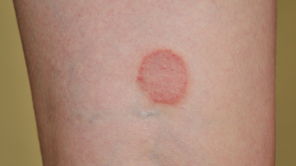 lichen planus